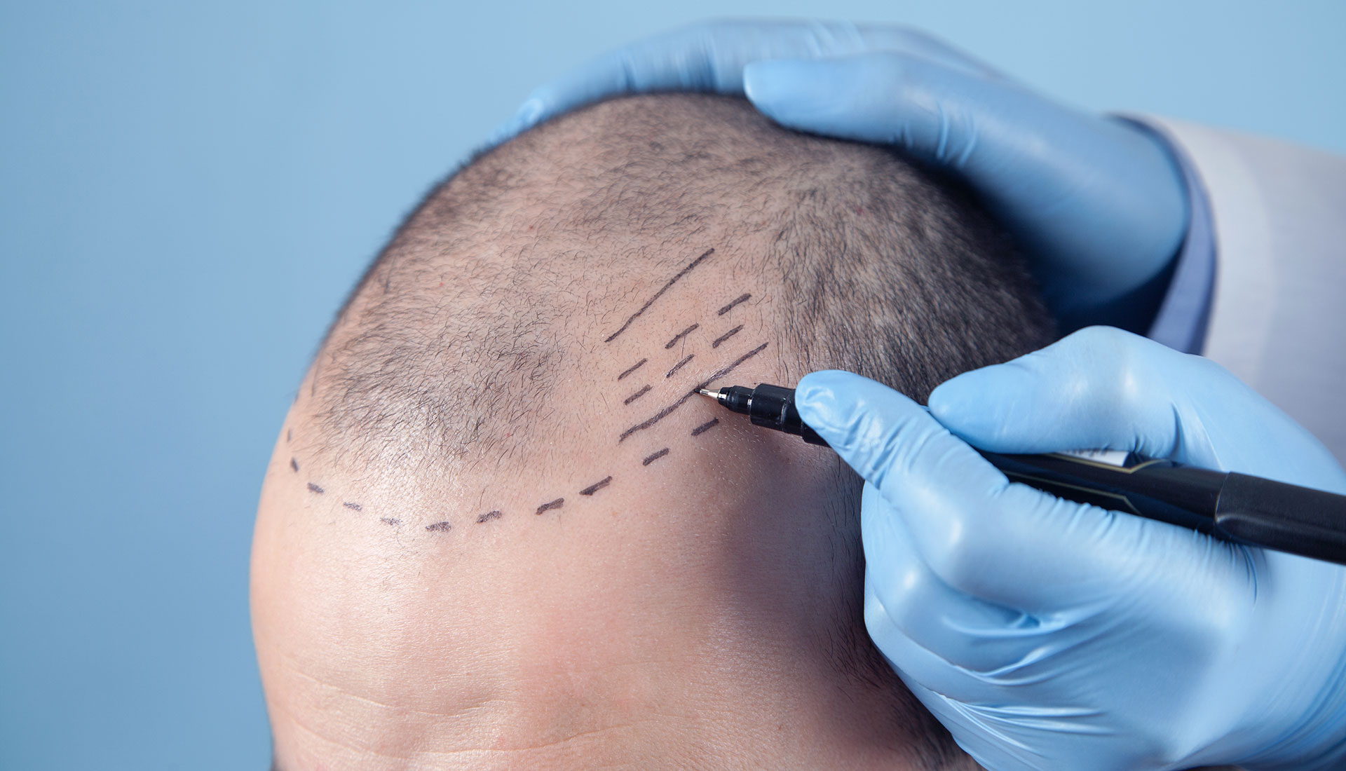 Supporting Healthy Hair & Scalp Recovery