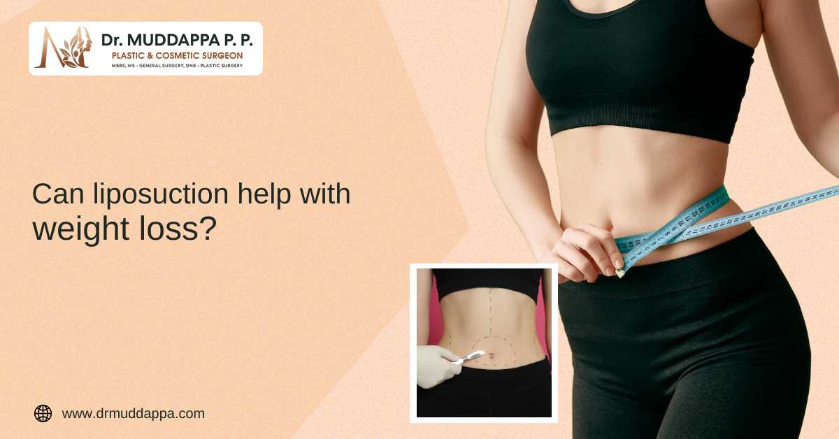 Can Liposuction Help with Weight Loss