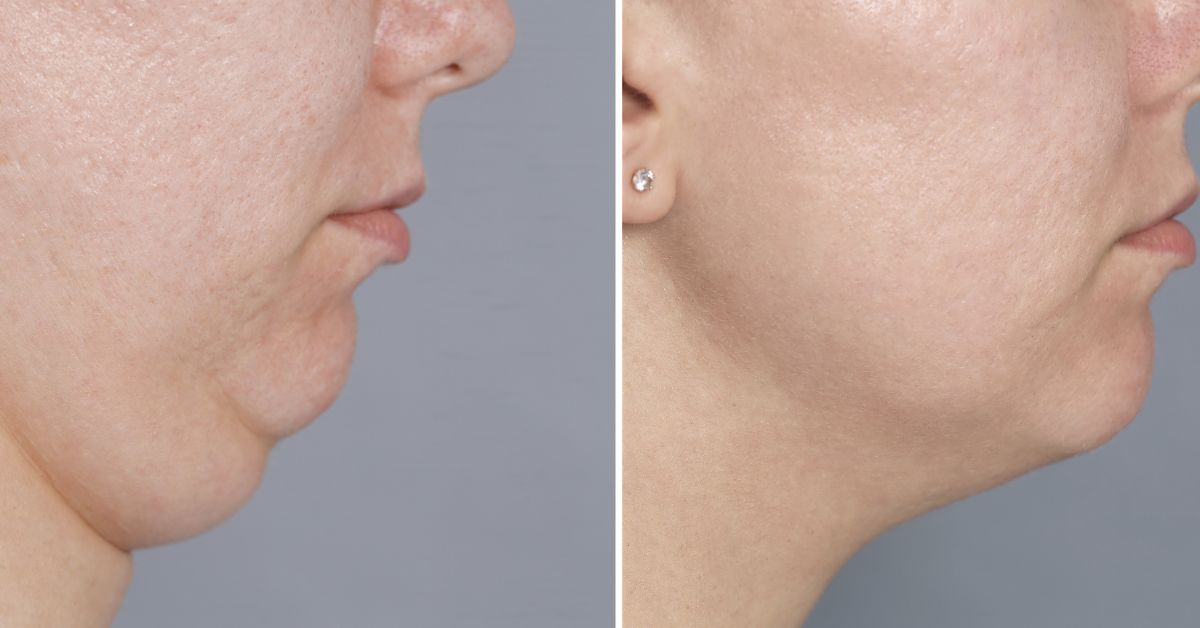 Before After Surgery.jpgadec - Dr. Muddappa P. P. Blog