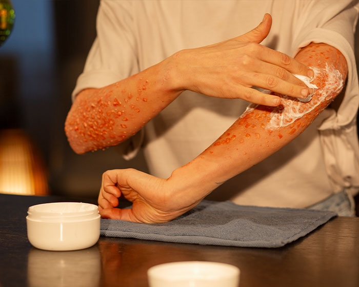 Burn Reconstruction