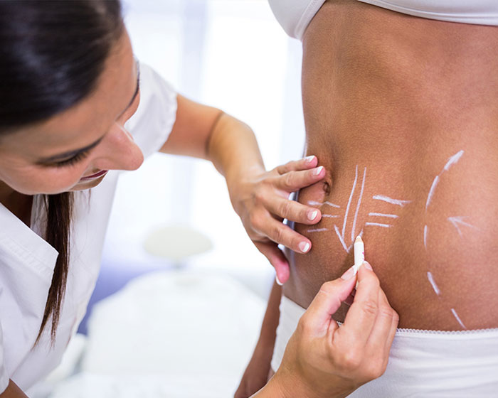 Liposuction