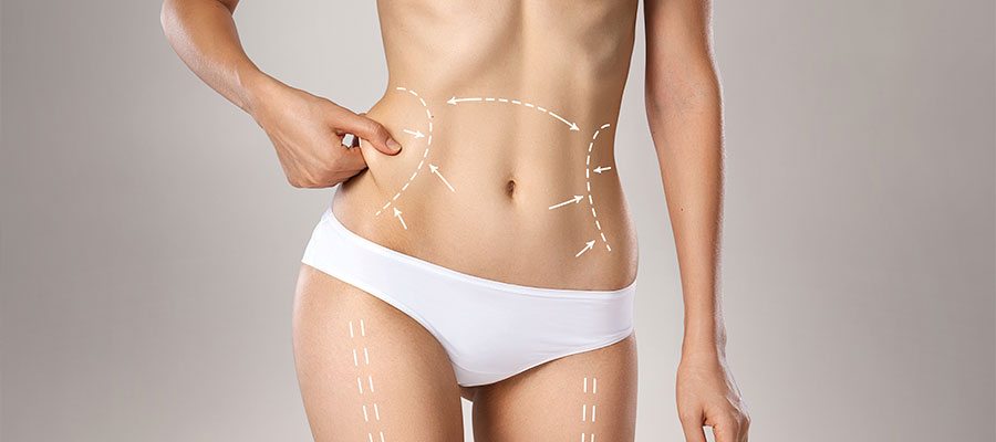abdominoplasty