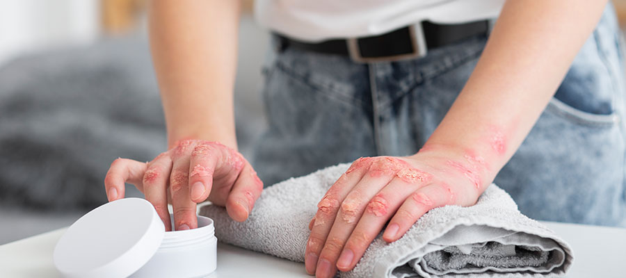 burn Hand Contracture Release