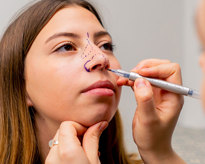 Rhinoplasty (Nose Surgery)