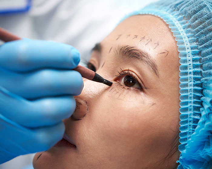 Eyelid Surgery (Blepharoplasty)